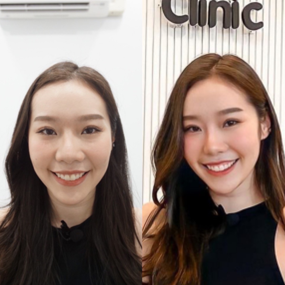รีวิว ไฮฟู่ Hifu Review fxc clinic facexercise clinic