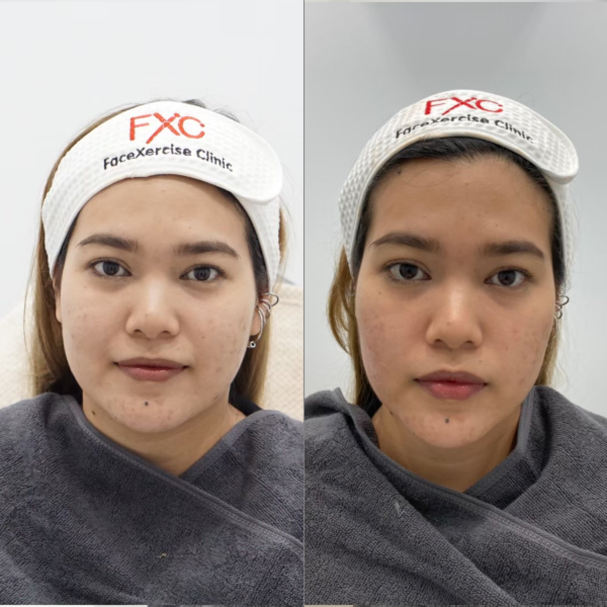 รีวิว ไฮฟู่ Hifu review facexercise clinic fxc clinic-6